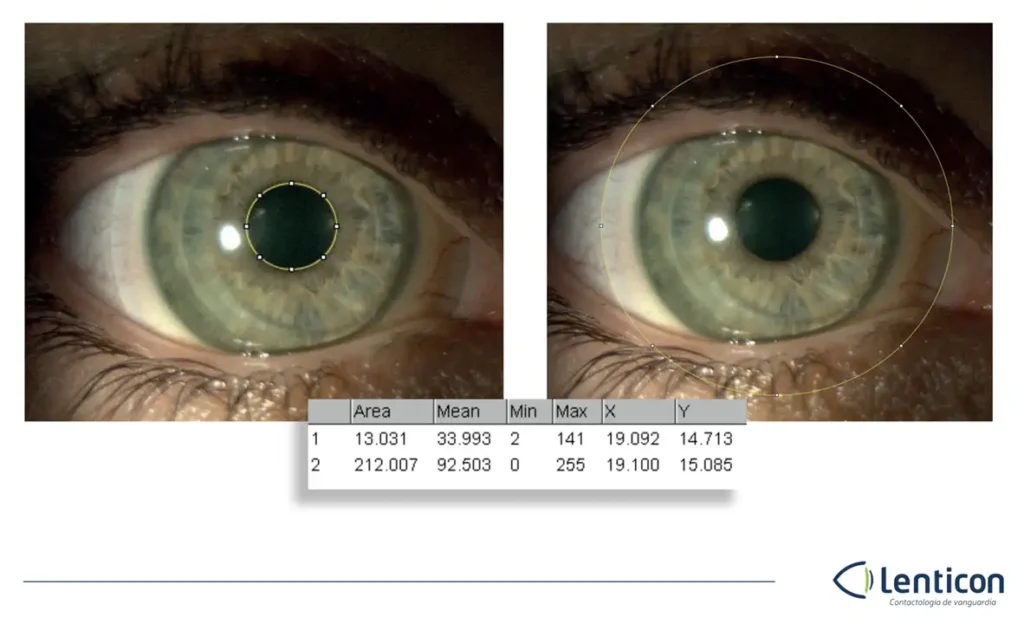 Determinar la zona óptica de la lente respecto del centro pupilar con software de procesamiento de imágenes ImageJ.