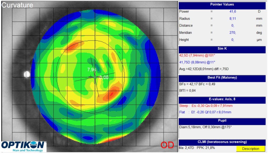 Moldeo corneal en una topografía